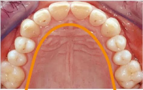 13 Mewing Mistakes That Can Hurt and Cause Pain.